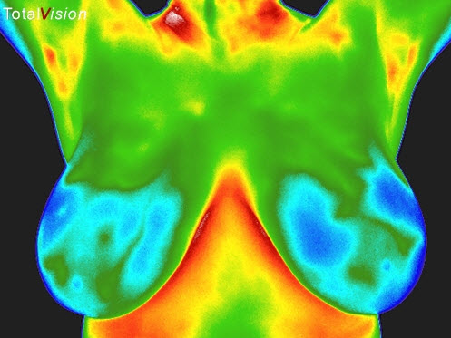 thermography 